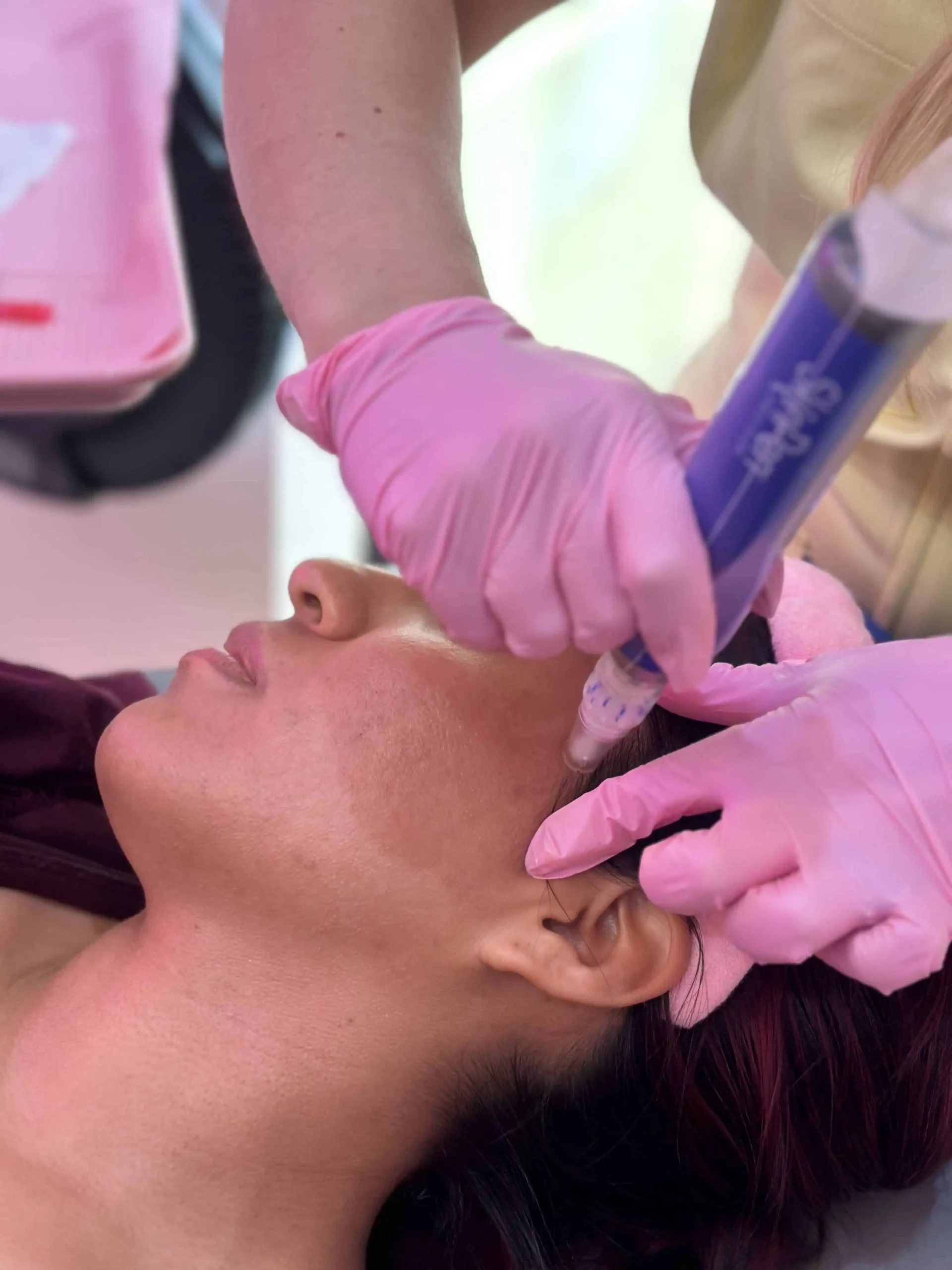 Microneedling with Salmon DNA | Centurion Injects